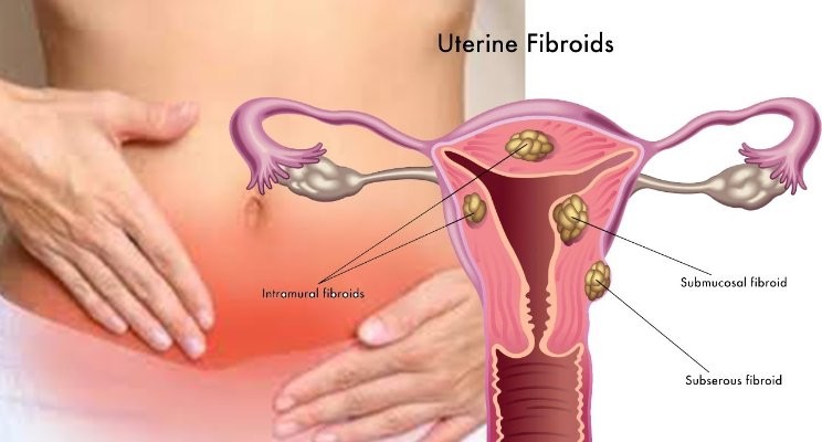 Fibroid Uterus Problems